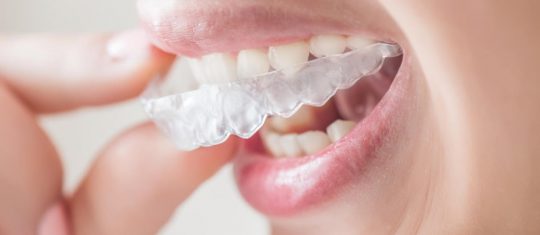 orthodontie-invisible