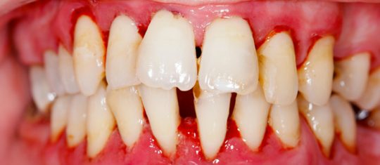 Traitement du déchaussement des dents