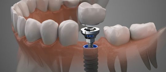 Pose d'implant dentaire