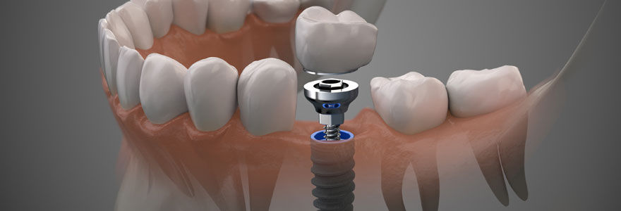 Pose d'implant dentaire